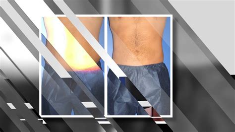 Abdomen Liposuction (Male Results) - Infini Phoenix Liposuction - YouTube