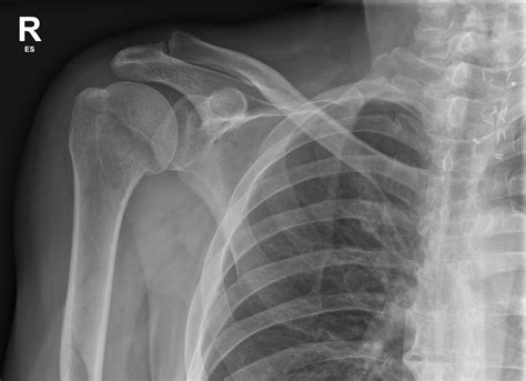 Left Humerus Fracture Radiograph Of The Left Humerus Shows An