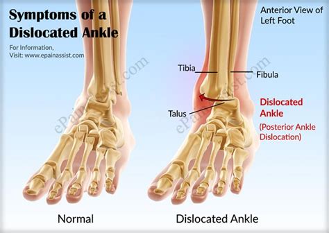 Dislocated Ankle|Treatment|Recovery|Prognosis|Causes|Symptoms