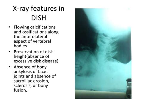 Diffuse idiopathic skeletal hyperostosis