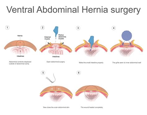 Ventral Hernia repair – GBMC Jordan