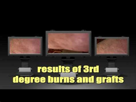 my leg after 3rd degree burns and skin grafts - YouTube