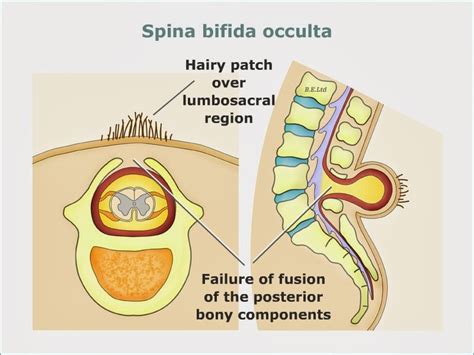 Spina Bifida Causes, SYmptoms, Diagnosis, Treatment, Prevention | Tips Curing Disease