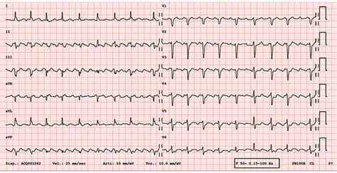 Typical Atrial Flutter And Ecg Mumuholo | Hot Sex Picture