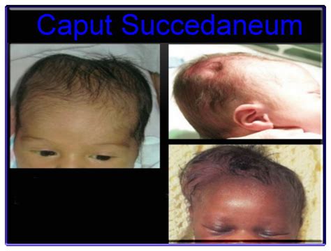 Caput Succedaneum And Cephalohematoma