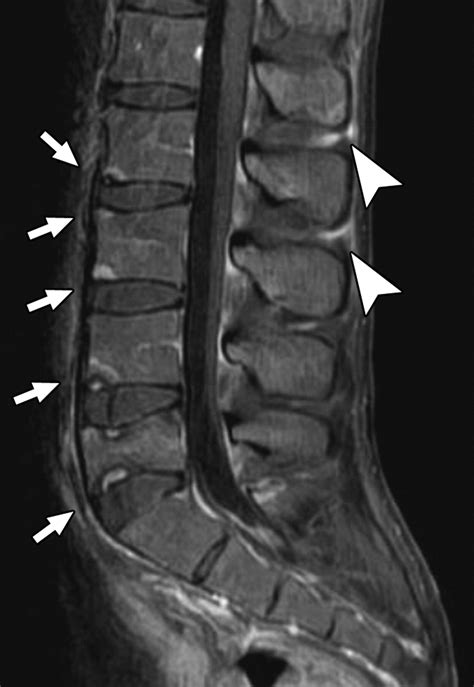 CT and MRI of Spine and Sacroiliac Involvement in Spondyloarthropathy | AJR