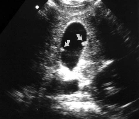 Abdominal ultrasound showing a polypoid lesion of the gallbladder... | Download Scientific Diagram