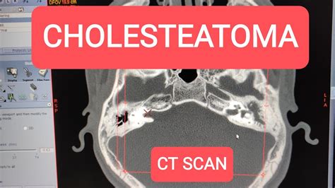 Prussak Space Ct Scan