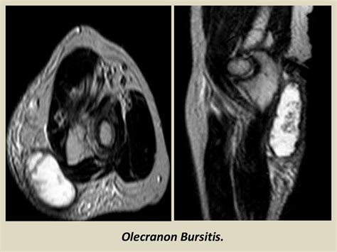 MRI Musculo-Skeletal Section: Bursa of elbow joint.