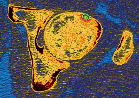 Osteoid osteoma, MRI scan - Stock Image - C014/2229 - Science Photo Library