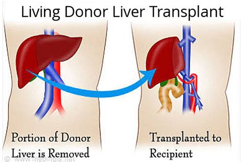 Liver transplant, The Only Hope for Those With Little Hope of Life – Dr Faisal Dar