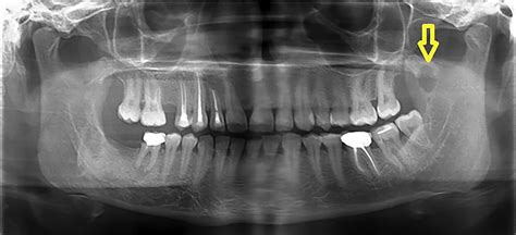 Cyst-like lesion in mandibular coronoid process: an unusual location ...