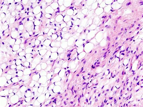 Liposarcoma; Liposarcoma, Dedifferentiated; Liposarcoma, Pleomorphic