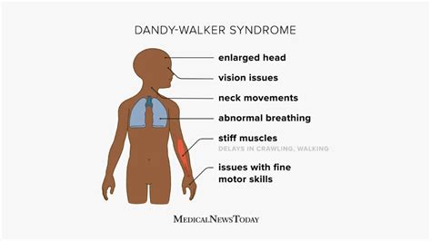 Dandy-Walker syndrome: Symptoms, causes, and more