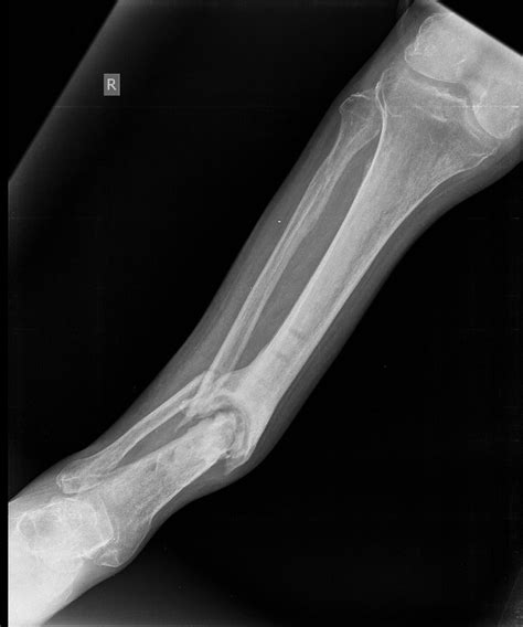 FRACTURE NON UNION AND PSEUDOARTHROSIS | Buyxraysonline