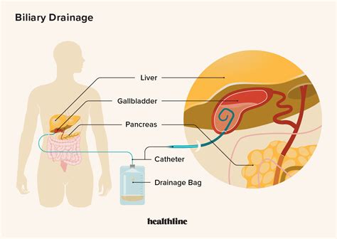 Share more than 118 bile drainage bag super hot - 3tdesign.edu.vn