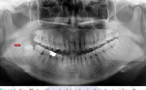 Figure 1 from The incidence of Oro-Maxillofacial lesions ( 10 years ...