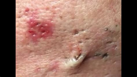 LARGE Blackheads Removal Best Pimple Popping Videos - YouTube