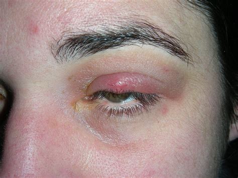 Eyelid lumps and lesions | The BMJ