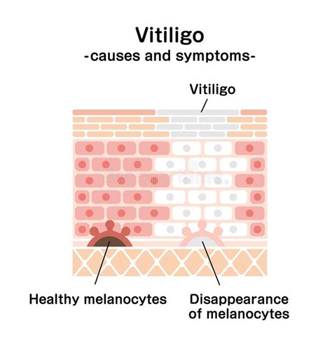 Causes and Symptoms of Vitiligo Vector Illustration Stock Vector - Illustration of vitiligo ...