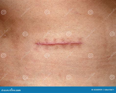 Scars from appendectomy stock image. Image of suture - 42500959