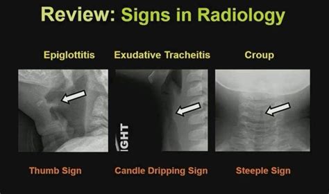 epiglottitis x ray - CindyteMckenzie