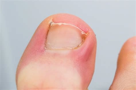 What Is An Ingrown Toenail?: Aloha Foot and Ankle Associates: Podiatry