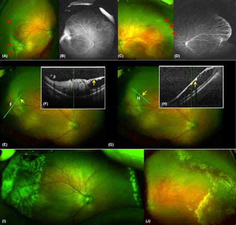 Case 3 -Flying baby OCT reveals peripheral epiretinal membrane and... | Download Scientific Diagram