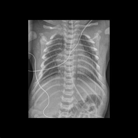 Premature newborn after umbilical arterial catheter placement ...