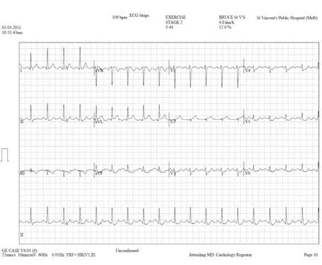 Abnormal Heart Stress Test Results