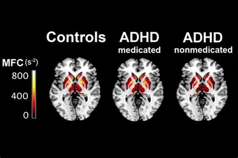 Adhd Brain