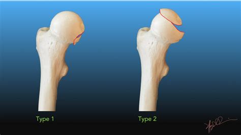 Pipkin Classification of Femoral Head Fractures | UW Emergency Radiology