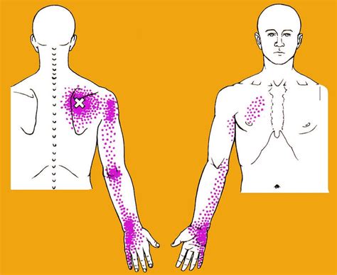 Chest Wall, Back and Thoracic Pain - Piedmont Physical Medicine ...