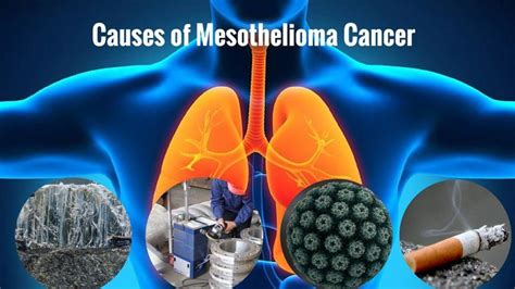 mesothelioma life expectancy after diagnosis #mesotheliomaattorneys ...