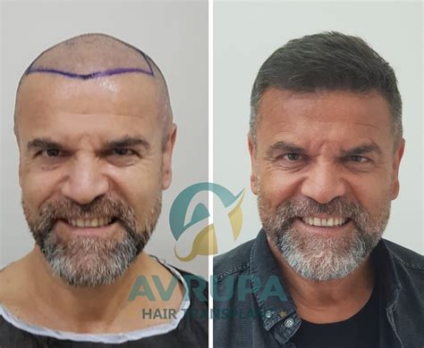 FUE Hair Transplant Results : 10 Real Cases With Photos - Clinic Advisor