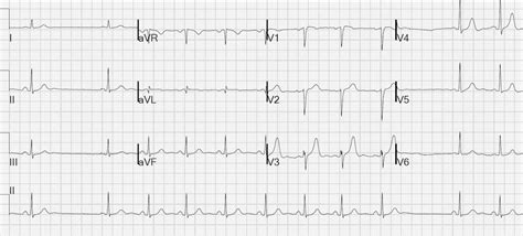 Sinoatrial Exit Block • LITFL • ECG Library Diagnosis