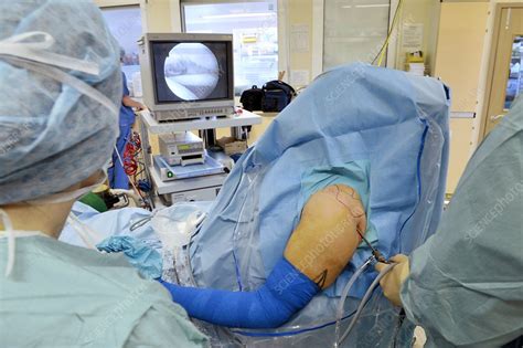 Shoulder arthroscopy procedure - Stock Image - M440/0245 - Science Photo Library