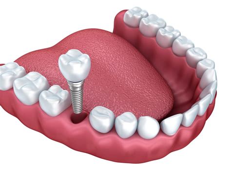 Implant-Supported Crown Chester Springs PA | Dental Implant