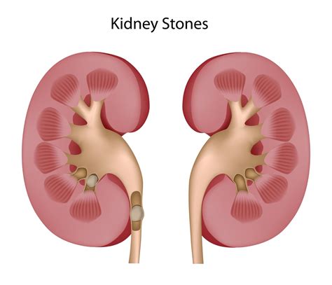 Kidney Stones Causes and Treatment Schemes | Doctor Tipster