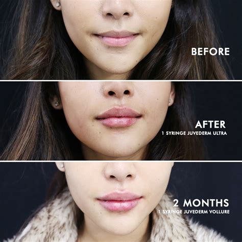 Big Lips Surgery Before And After | Lipstutorial.org