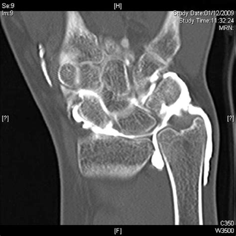 CT arthrogram showing contrast leak through TFCC tear | Download ...