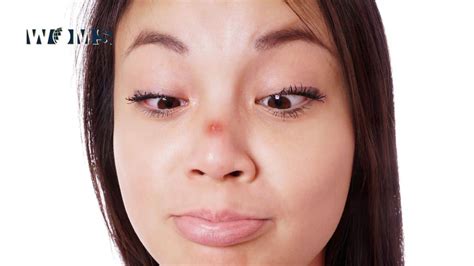 Understanding and Managing Pimple Nose: Types, Causes, and Treatment - WOMS