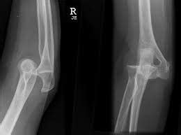 Elbow Dislocation - Trauma - Orthobullets