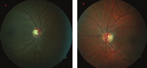 Fundus photography of the right eye (a) shows “darker fundus” (more... | Download Scientific Diagram