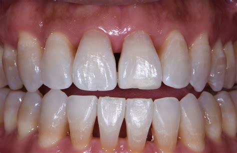 How Bioclear Empowers Dentists To Treat Black Triangles - Optident