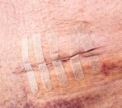 Steri-Strips for Wound Closure | Praxisdienst Online Shop