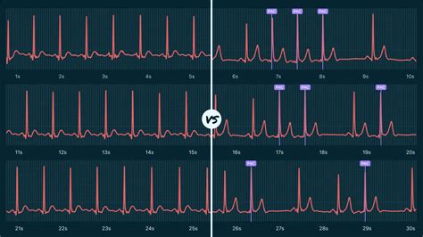 Sinus Rhythm Vs. Ectopic Atrial Rhythm on Your Watch ECG | Qaly