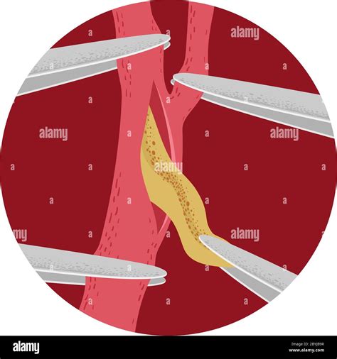 Illustration of Carotid Artery Surgery Removing the Plaque Using Hemostat Stock Photo - Alamy