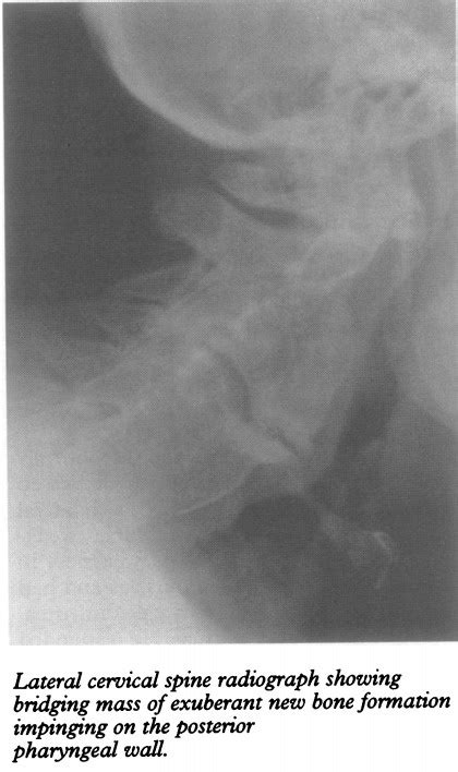 Case report: dysphagia and sleep apnoea associated with cervical osteophytes due to diffuse ...