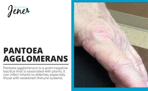 Causes Of Pantoea Agglomerans And It's Treatments